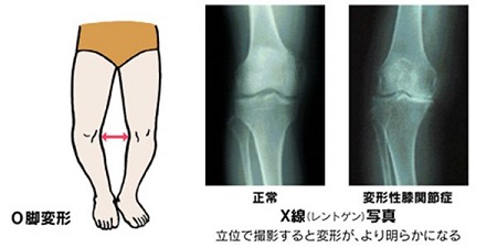変形性膝関節症のO脚変形・X線写真